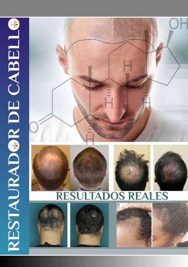 ⒺⓈ » Sistema Anti Calvicie PDF-Libro, Jared Gates