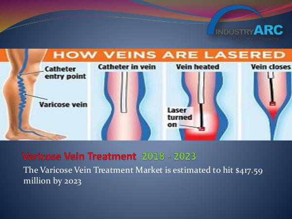 Varicose Vein Treatment Market