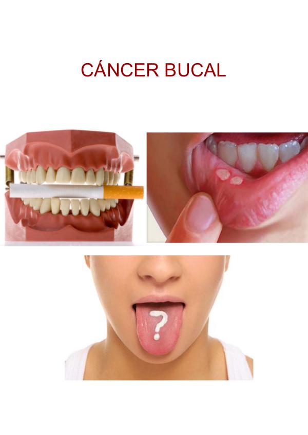 Cáncer bucal Cáncer Oral